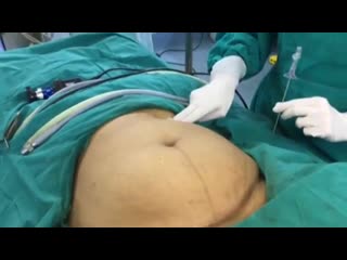 navel surgery training